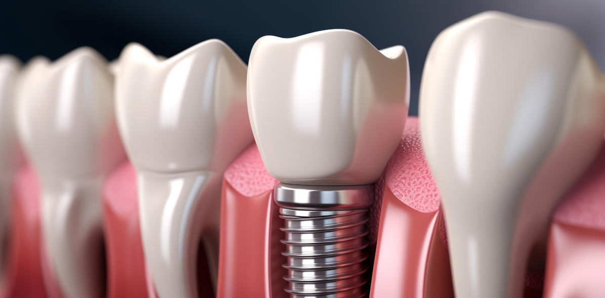 Grafik des Aufbaus eines Zahnimplantats