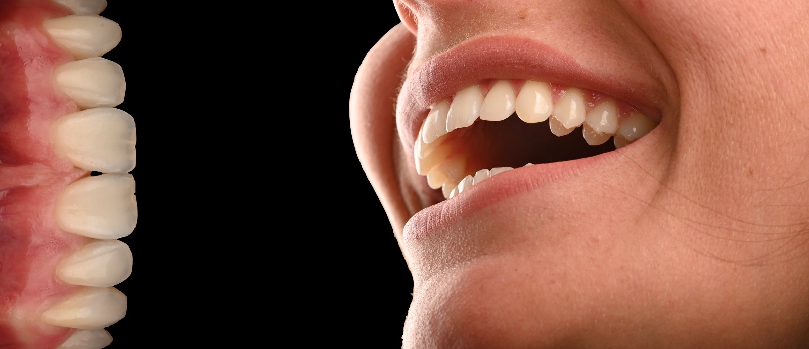 Veneers-Behandlung für Zähne in Nürnberg mit individuell im Eigenlabor gefertigten Keramikveneers