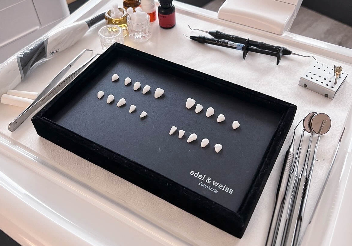 Veneers aus dem Meisterlabor von edel & weiss Zahnärzte in Nürnberg mit höchster Präzision gefertigt