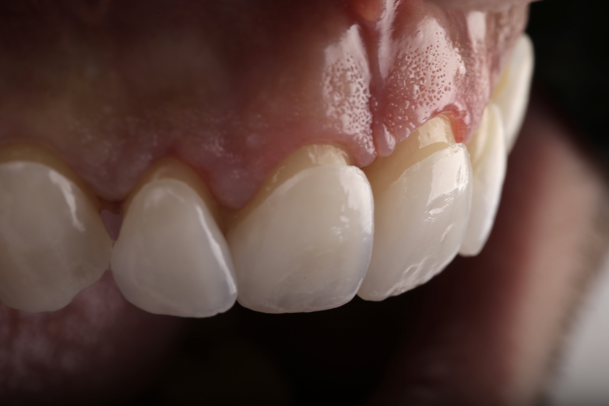 Ultrahauchdünne Keramik-Veneers mit höchster Ästhetik und Präzision bei edel & weiss Zahnärzte