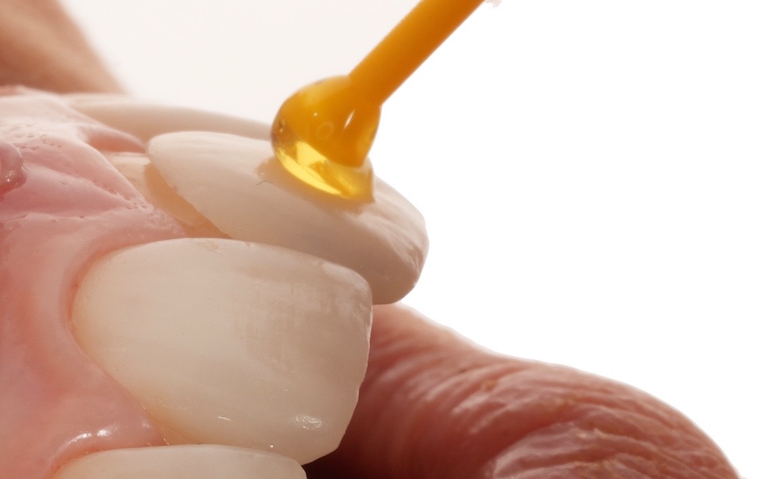 Veneers Behandlung in einer Zahnarztpraxis in Nürnberg mit Veneers aus dem praxiseigenen Labor gefertigt