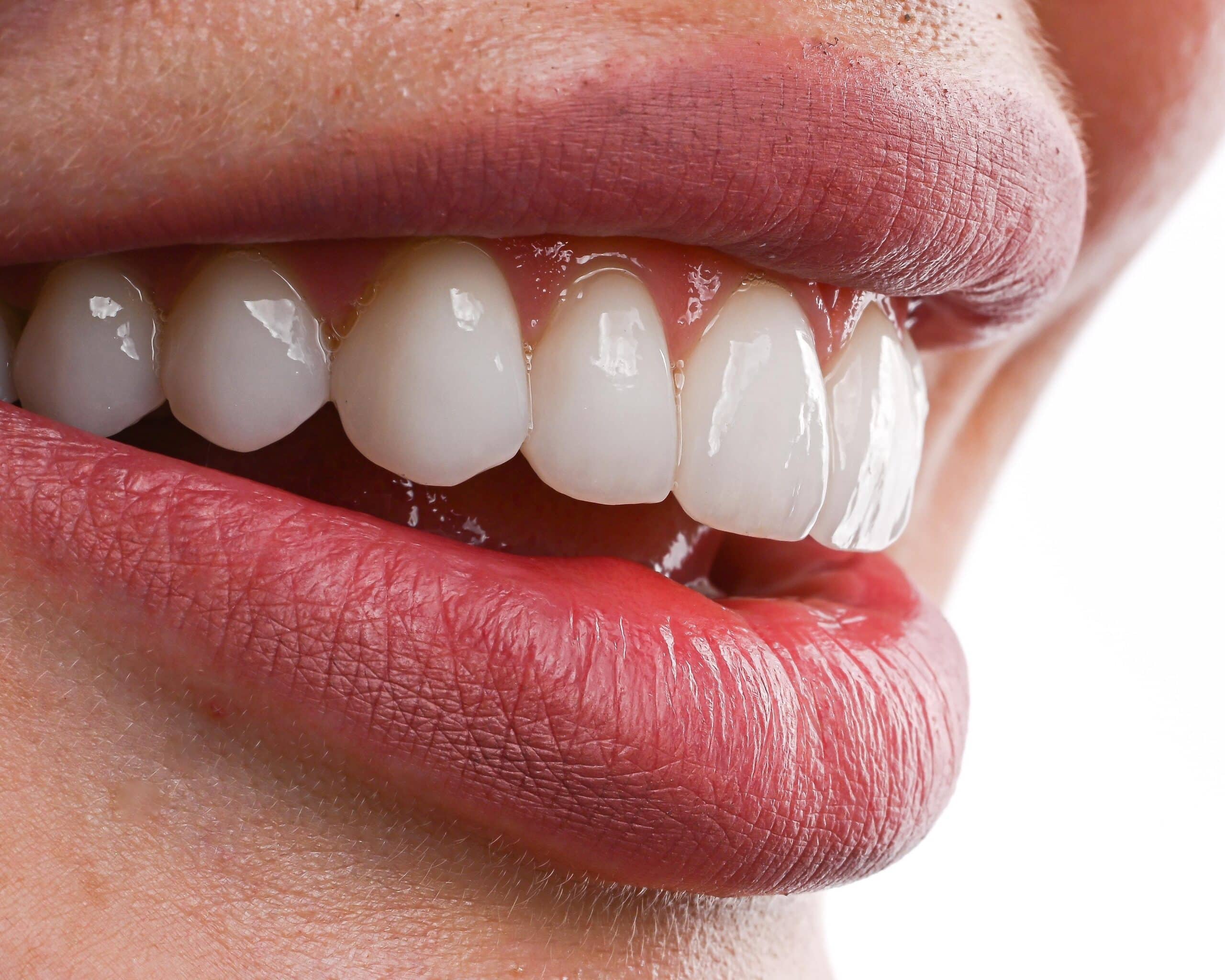 Ästhetische Veneers für perfekte Zähne, natürliches Lächeln durch hochwertige Keramikverblendschalen